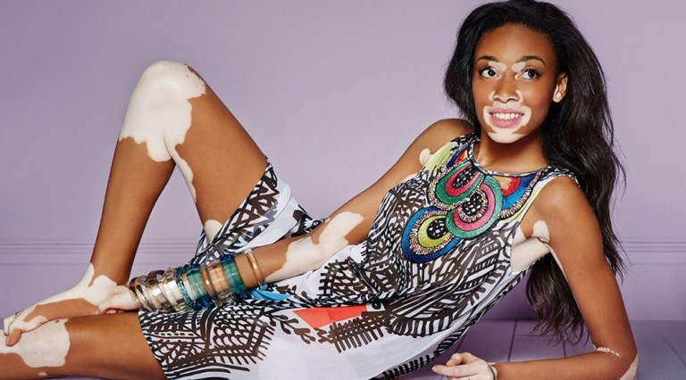 Durch das kanadische Top-Model Winnie Harlow wurde die Pigmentstörung Vitiligo bekannt. Alles über die Ursachen und die neuesten Behandlungsmöglichkeiten auf www.marinajagemann.com