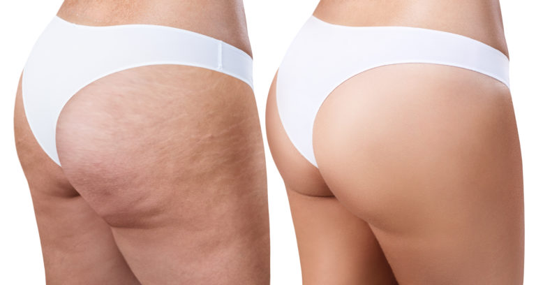 Cellulite wegcremen, vorher nachher, Marina Jagen