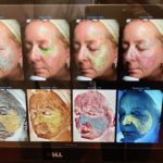 Face-Contouring, Hyaluron-Filler, Filler, Falten-Unterspritzung, Juvéderm, Klinik am Rhein, Dr. Manassa, Allergan, Marina Jagemann