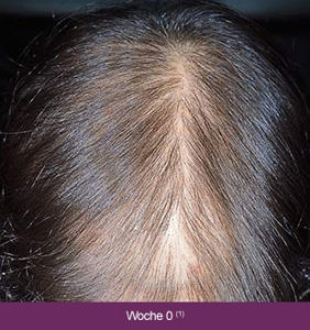 Minoxidil, Marina Jagemann, Haarausfall, feines Haar, dünnes Haar, Menopause, Wechseljahre, erblich bedingter Haarausfall,