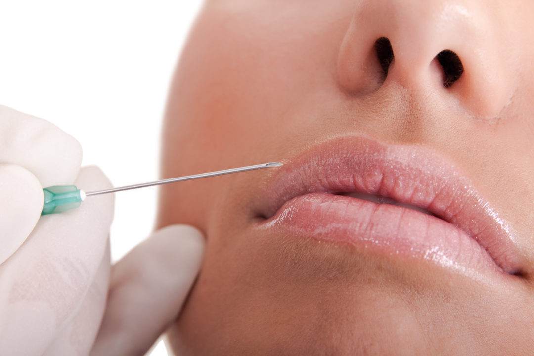 Lippen mit Filler aufspritzen