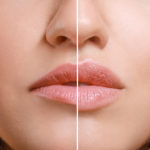 Lippen vorher nachher