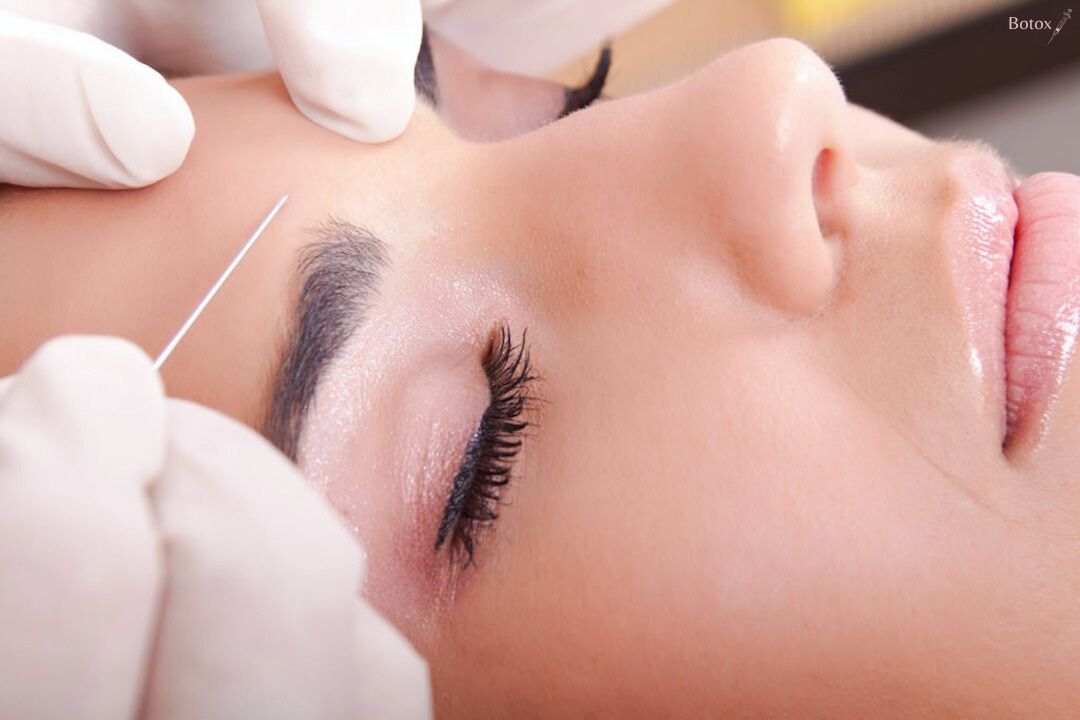Botox Behandlung an der Stirn von einer Frau