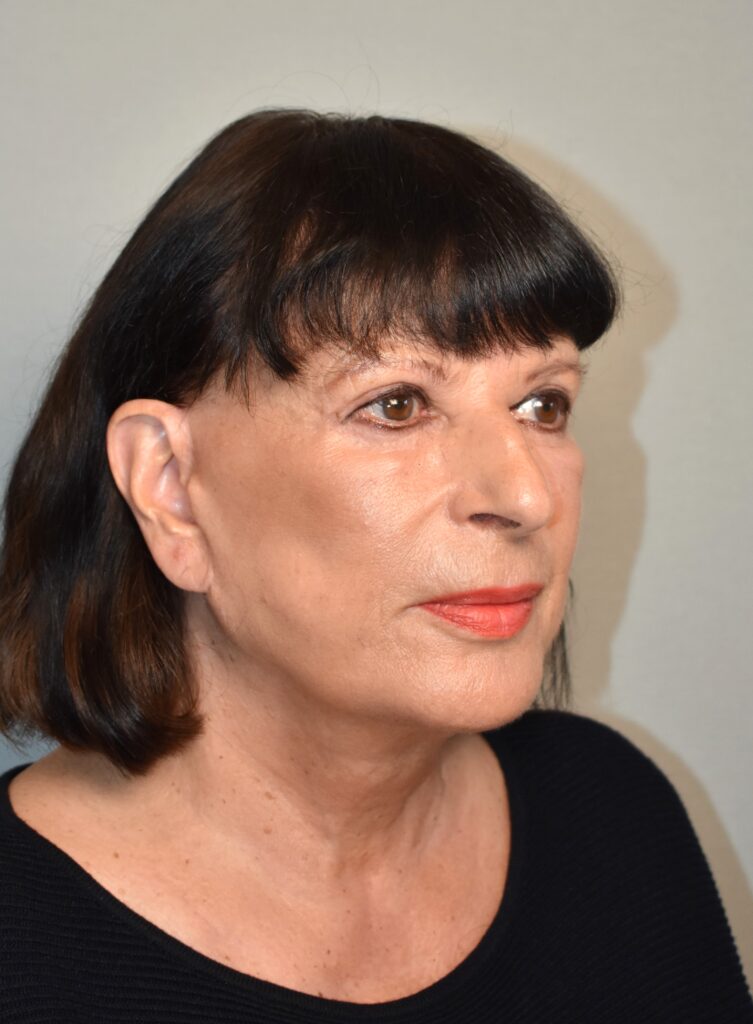 Facelifting Erfahrungsbericht