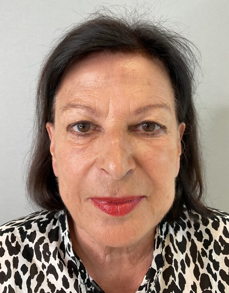 Facelifting Erfahrungsbericht