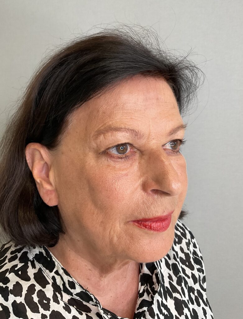 Facelifting Erfahrungsbericht