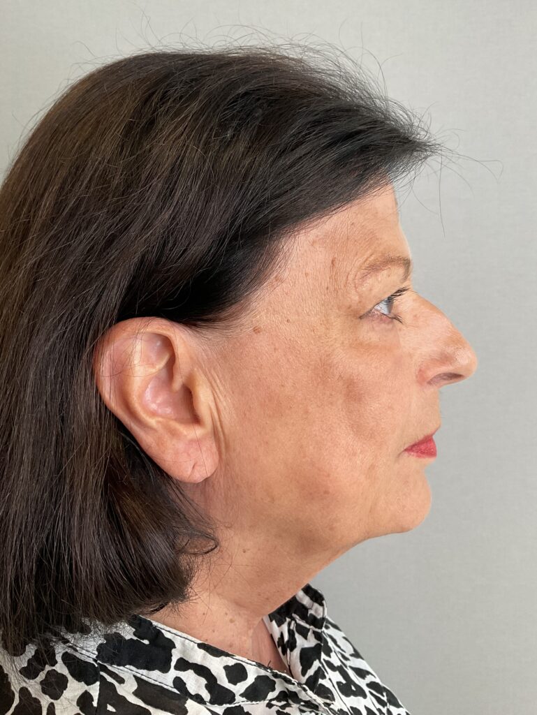Facelifting Erfahrungsbericht
