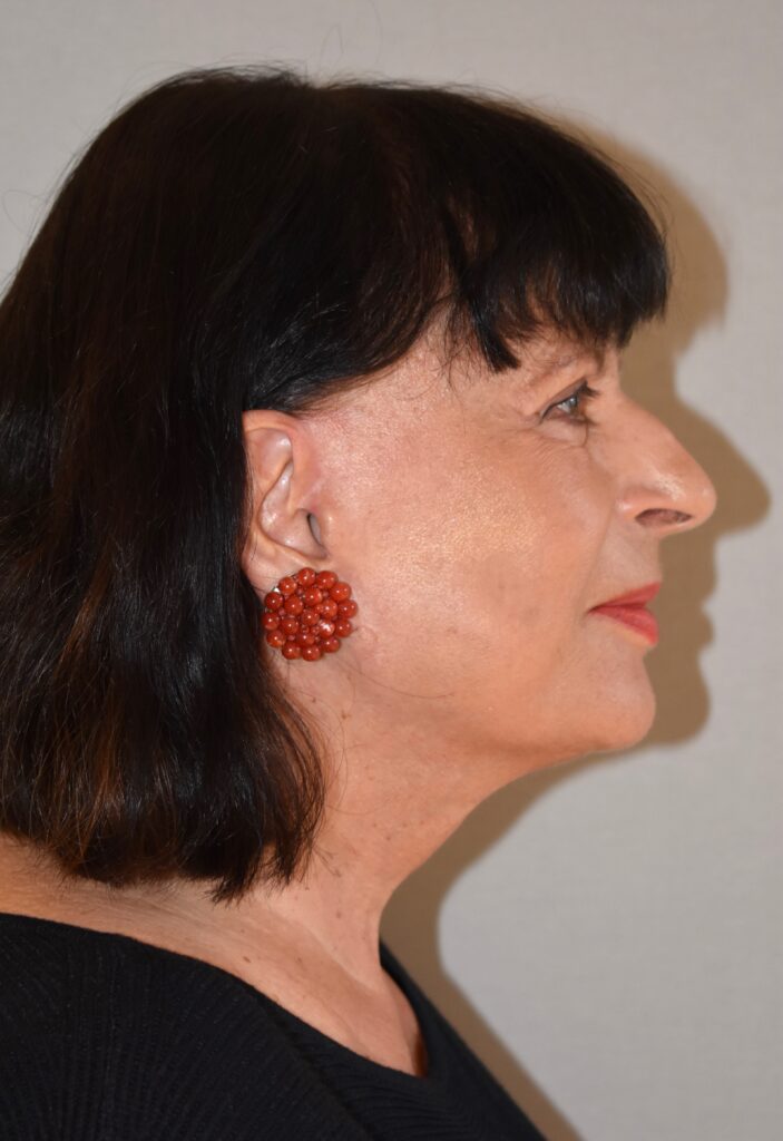 Facelifting Erfahrungsbericht